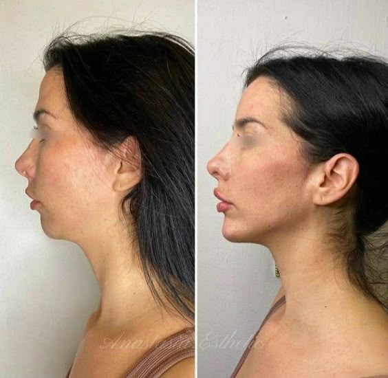The 90-Second De-Puffer | Electric Gua Sha for Jawline Definition